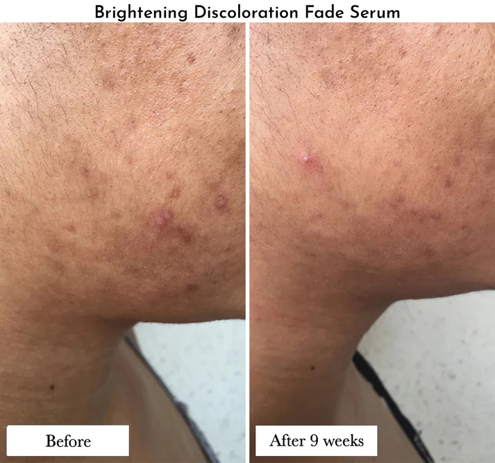 Junederm Brightening Discoloration Fade Serum - Image 3